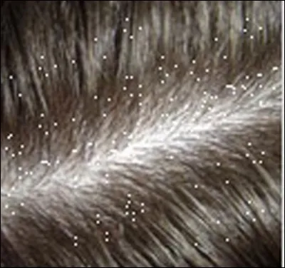 The hair dandruff is a part of :
