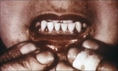 Scurvy results from a lack of vitamin ...