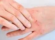 Quiz Les maladies éruptives - vrai ou faux ?