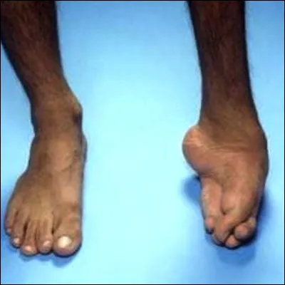 Which Frankish queen owes her nickname to the fact that she had a club foot?