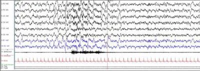These two epochs would be scored as having arousals