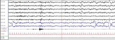 These two epochs would be scored as having arousals