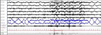 These two epochs would be scored as having arousals