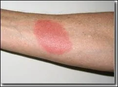 In 2007 it was reported by RoSPA that 12 people sustained burns at Christmas when doing what?