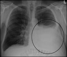 This radiograph illustrates which pathological condition?