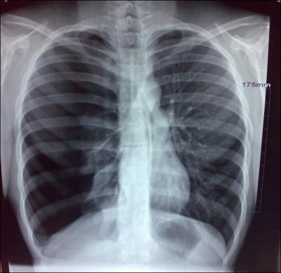 This radiograph illustrate which pathological condition?