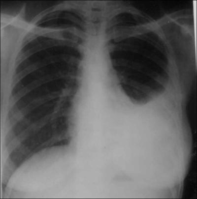 This radiograph illustrates which pathological condition?