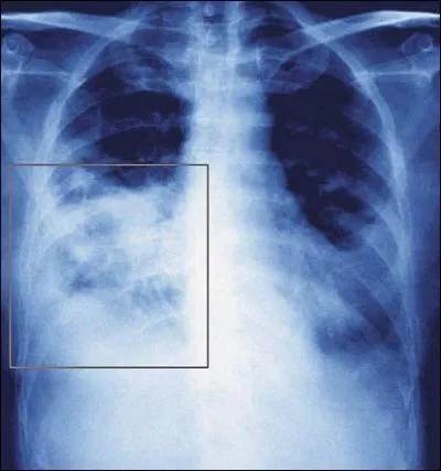 This radiograph illustrates which pathological condition?