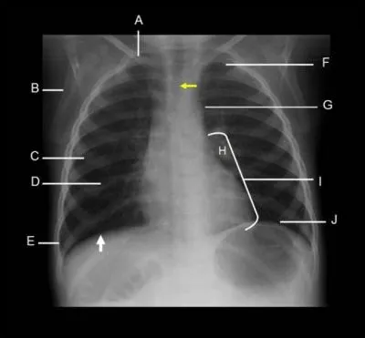 Which letter illustrates the Scapula?