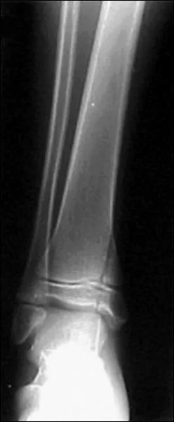 Which Salter-Harris classification is this fracture? Which Salter-Harris classification is this fracture?