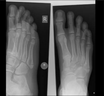 Which eponymous fracture is this? Which eponymous fracture is this?