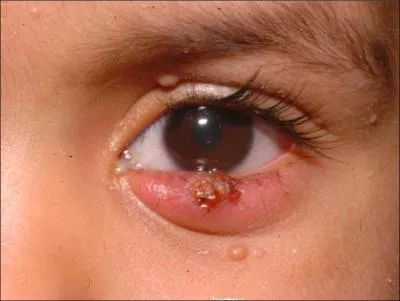 What is the diagnosis?