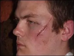 He has a ________ on his face.