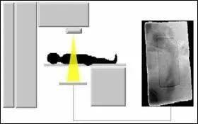 The side effects from radiotherapy can be long term and short term. What is a long term effect of radiotherapy from the list below?