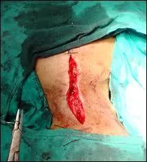 When creating an incision within the body their is a chance of infection. On a scale of minor, standard, major. What is the chance of infection?