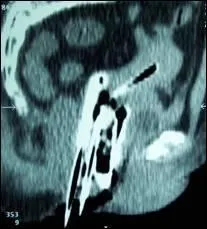 What is internal radiation?