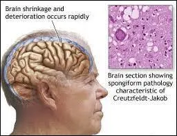 What are some symptoms of Mad Cow Disease?