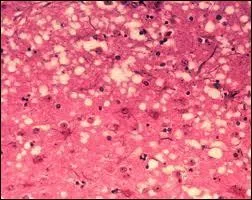 What is a prion in Mad Cow Disease?