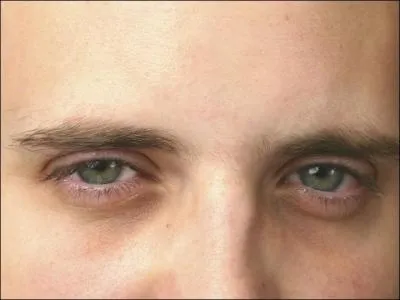 What squinted eyes of this man clearly suggests?