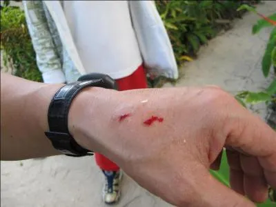 Jackie has had many injuries over the years, but which everyday activity often leaves him injured?