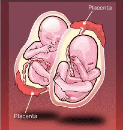 Will these twins be identical?