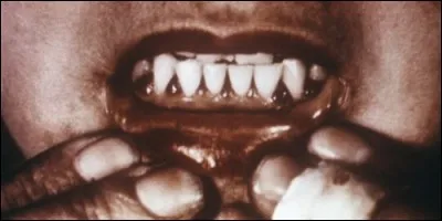 What disease is caused by a lack of vitamin C?